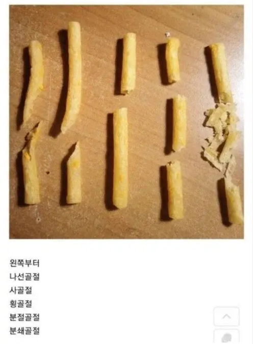 감자튀김으로 알아보는 골절