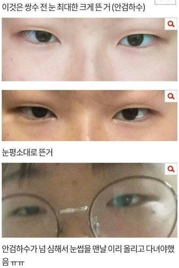 쌍수 후기녀