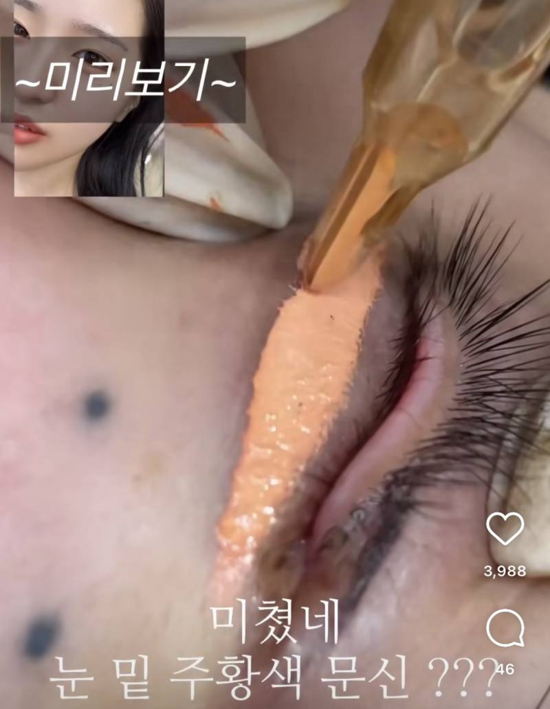 눈 밑 애교살 반영구..jpg27