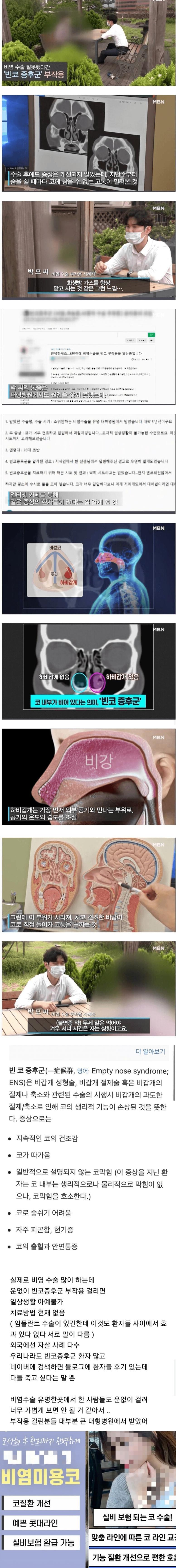 극단적 선택 사례까지 나온다는 비염수술 부작용.jpg