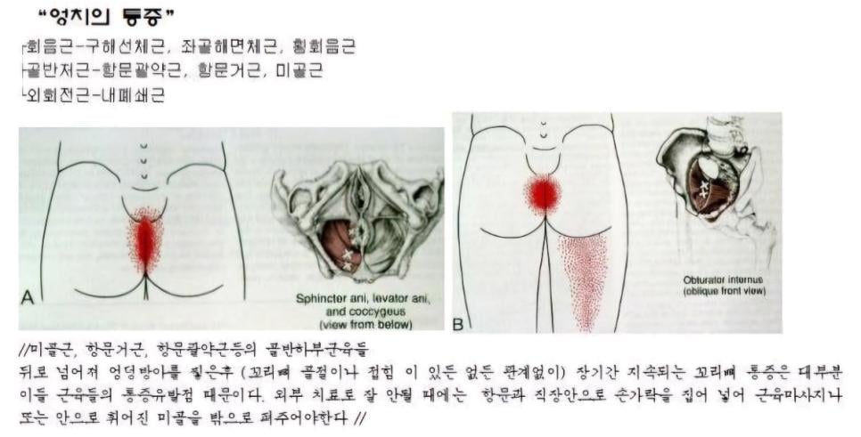 항문에 직접손을 넣어 척추교정하는 미골교정.jpg