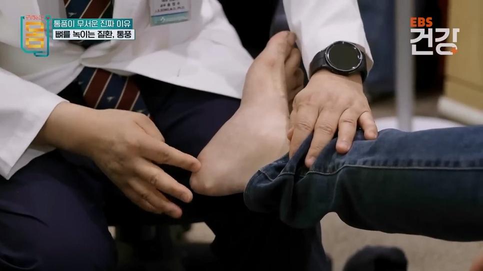 30대 통풍 환자의 발상태 .jpg