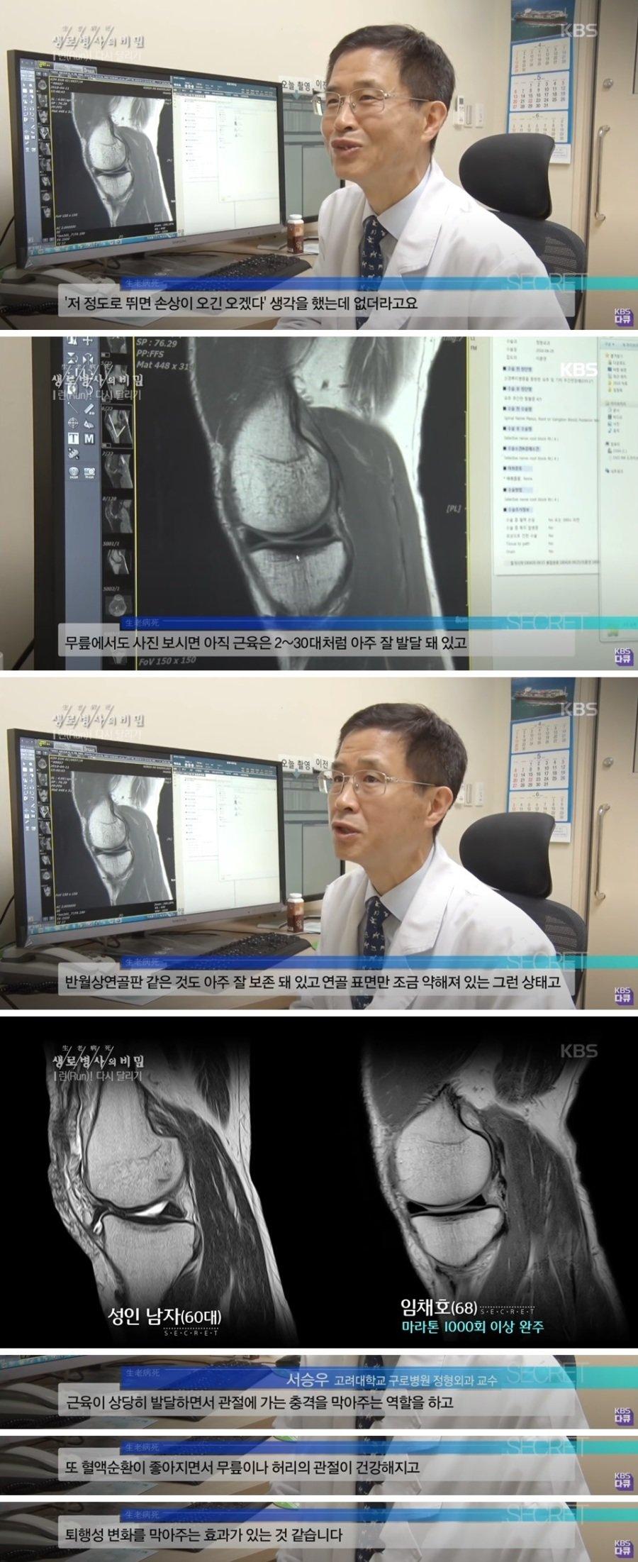 마라톤 1000회 완주한 노인의 무릎상태..jpg