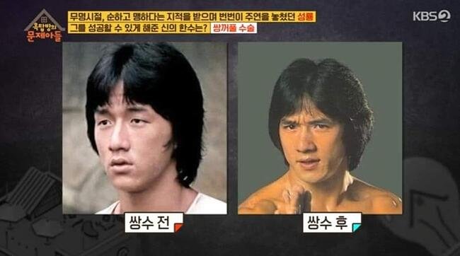 역대급 쌍꺼풀 수술 성공자