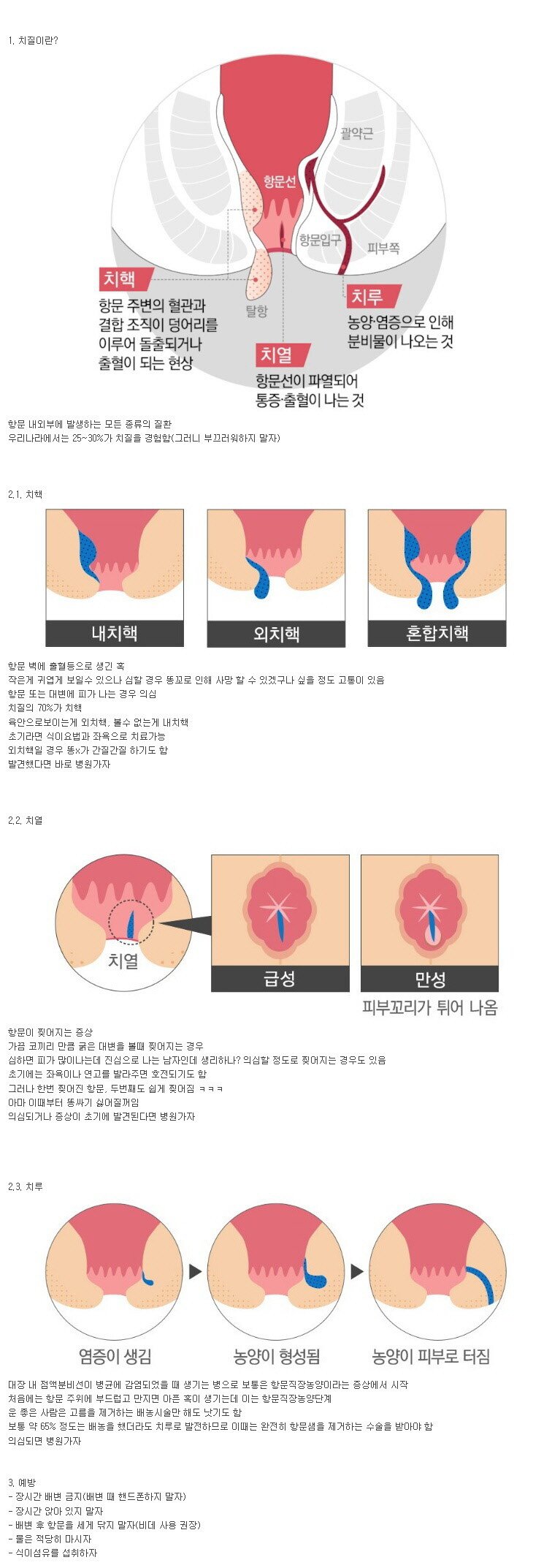 현대인들의 질병 치질..jpg