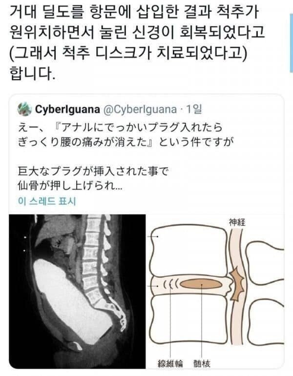 신박한 디스크 치료법