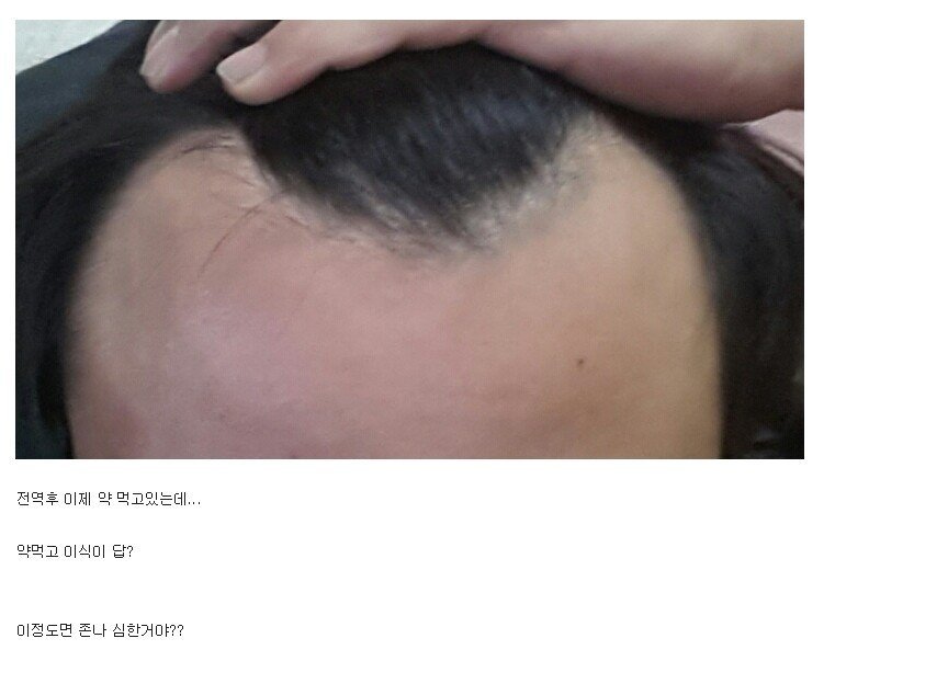 탈모가 무서운 이유.jpg