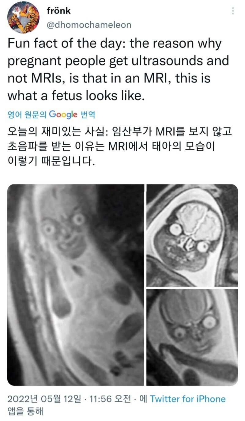 태아 사진을 MRI가 아닌 초음파로 찍는 이유.JPG