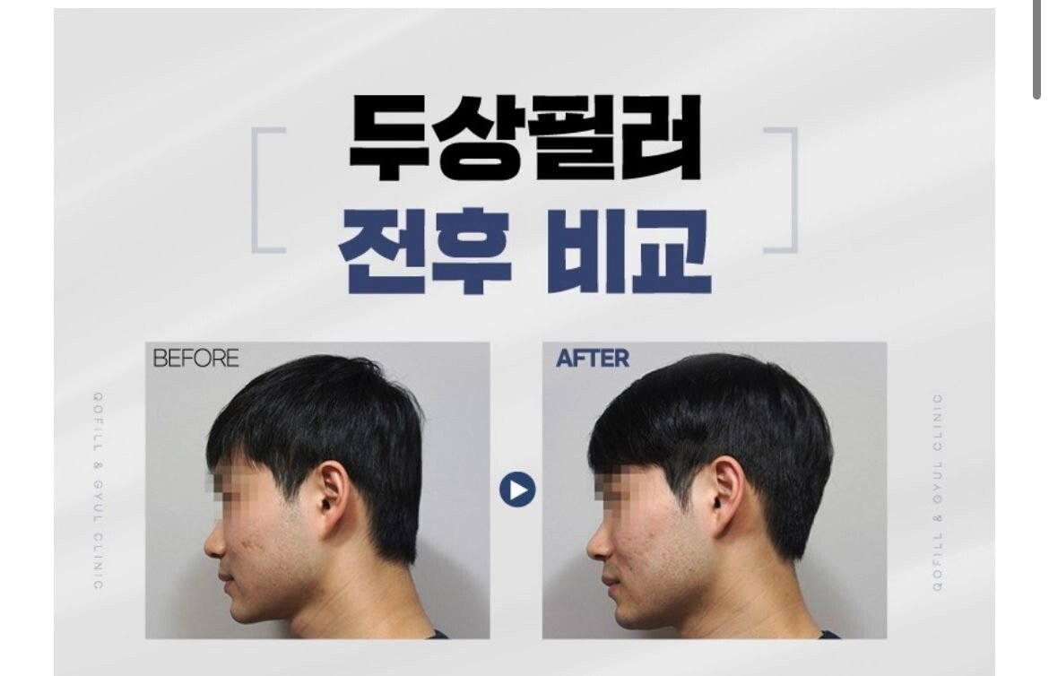 남자들이 의외로 많이하는 성형.jpg